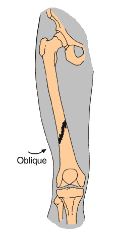 Fracture type - Oblique diagram