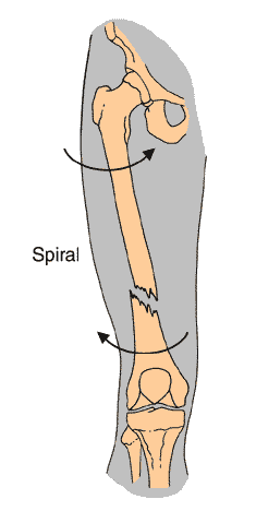 Fracture type - Spiral diagram