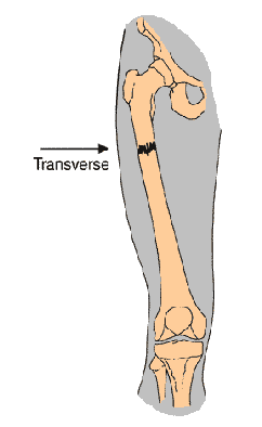 Fracture type - Transverse diagram